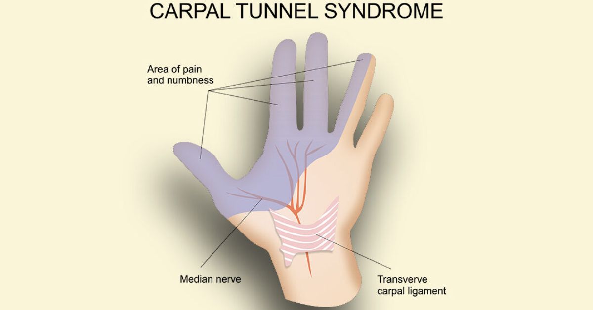 Preventing Carpal Tunnel Syndrome From Gaming Hand Health Tips
